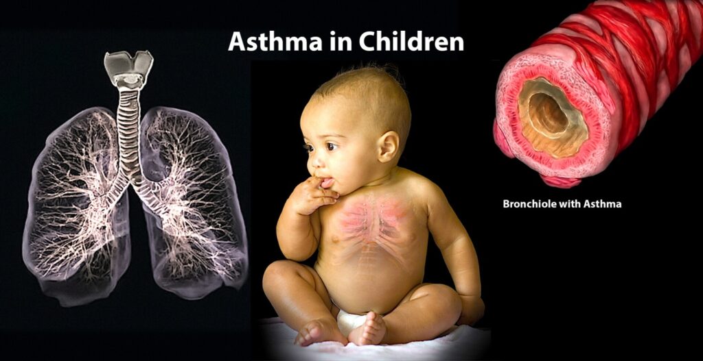 ASTHMA