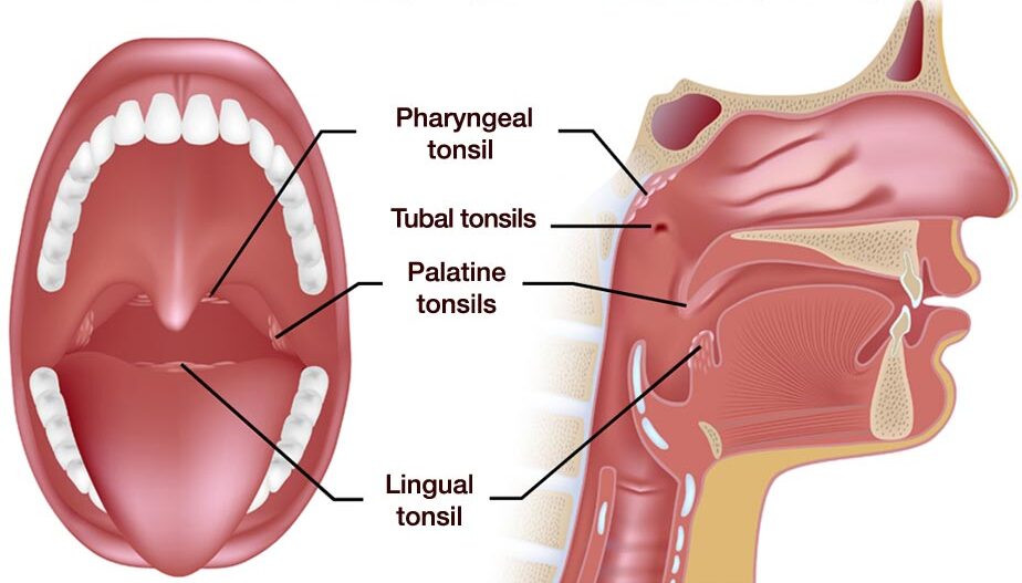 Tonsillitis