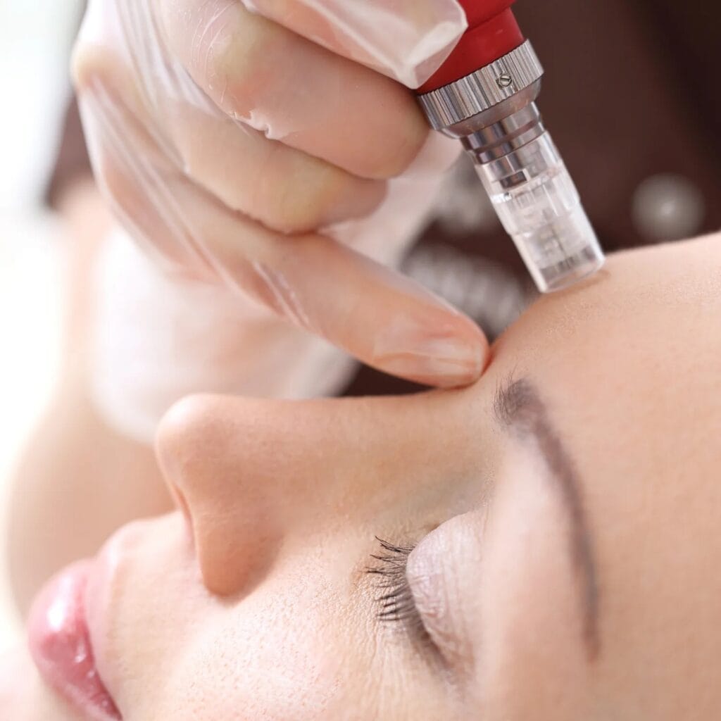 THE VERSATILE BENEFITS OF MICRO-NEEDLING